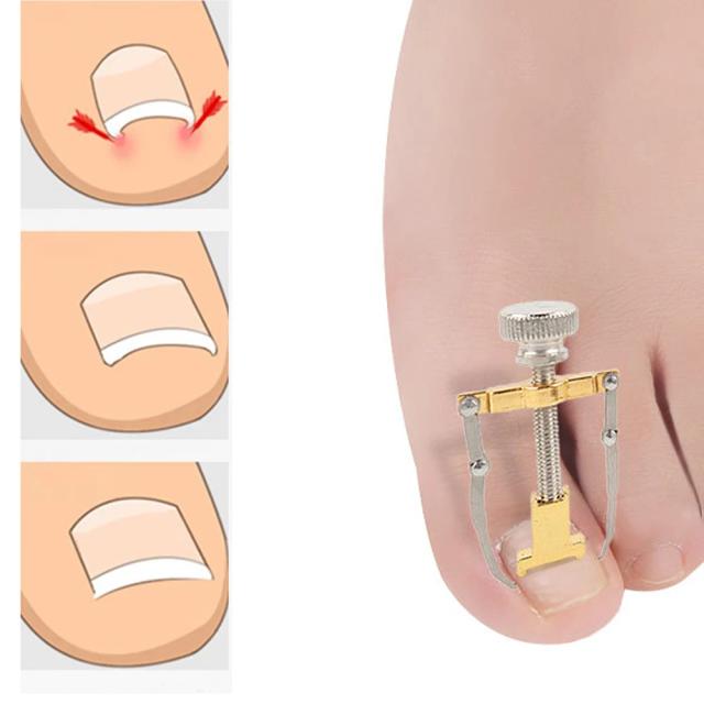 Ingrown Toe Nail Corrector Pedicure Tool for Foot Care Toe Clipper Remover Kit Detox Machine Onyxis Bunion Precision Woman Man on Productcaster.