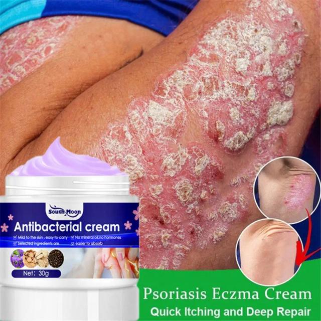 Itching Cream External Use Anti-Itching Skin Problems Dermatitis Eczema Treatment Psoriasis Cream Antibacterial Cream on Productcaster.