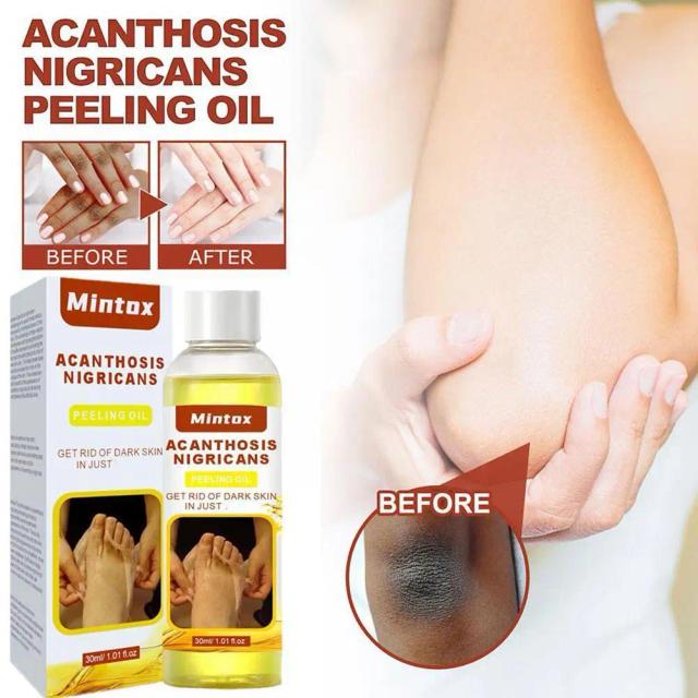 30ml Peeling Oil Dark Skin Bleaching Remove Arm Knee Scrub Dead Body Lightening Exfoliating Serum Whitening Skin Legs Melan Q9M3 on Productcaster.