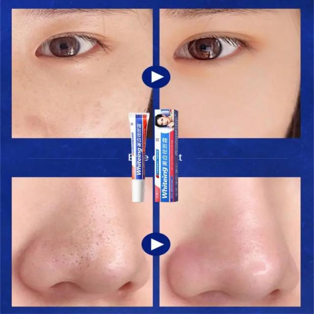 Effective Whitening Freckle Cream Remove Dark Spots Anti Freckle Cream Fade Pigmentation Melasma Brighten Creams Skin Care 20g on Productcaster.