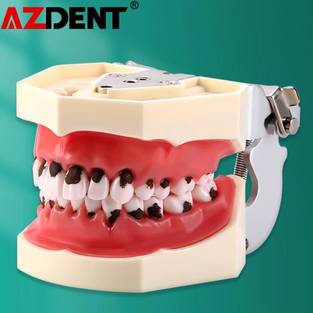 Dental Calculus Teaching Model Periodontal Disease Model on Productcaster.