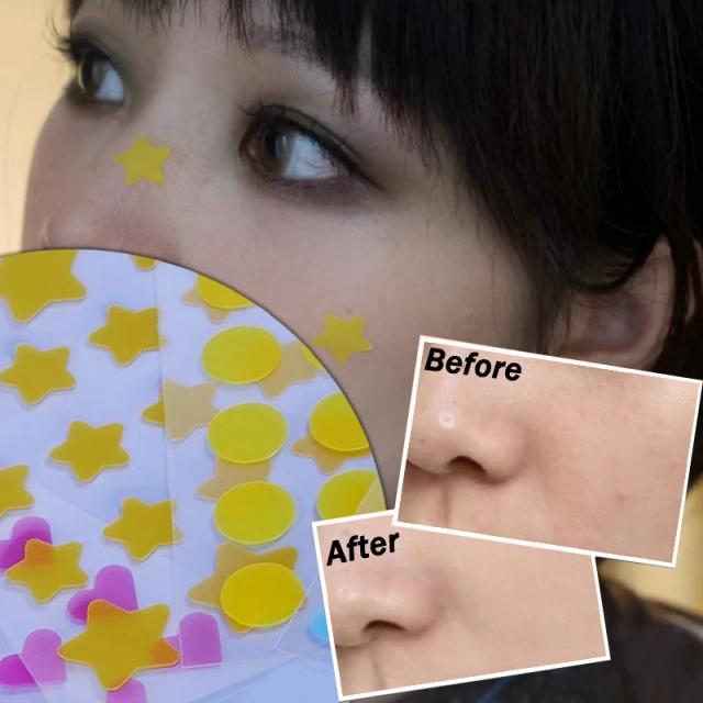 Star Pimple Patch Acne Colorful Invisible Acne Removal Skin Care Stickers Y2K Originality Concealer Face Spot Beauty Makeup Tool on Productcaster.