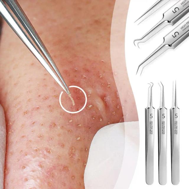 Cell Pimples Blackhead Remover Clip Ultra-fine Tweezers Dots Blackhead Extractor Skin Needle Acne Black Cleaner Care Facial Z1Z0 on Productcaster.