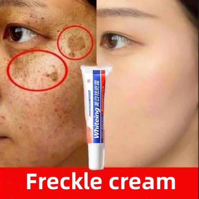 Whitening Freckles Cream Remove Melasma Dark Spot Lightening Melanin Removal Melasma Remover Moisturize Brighten Face Skin Care on Productcaster.