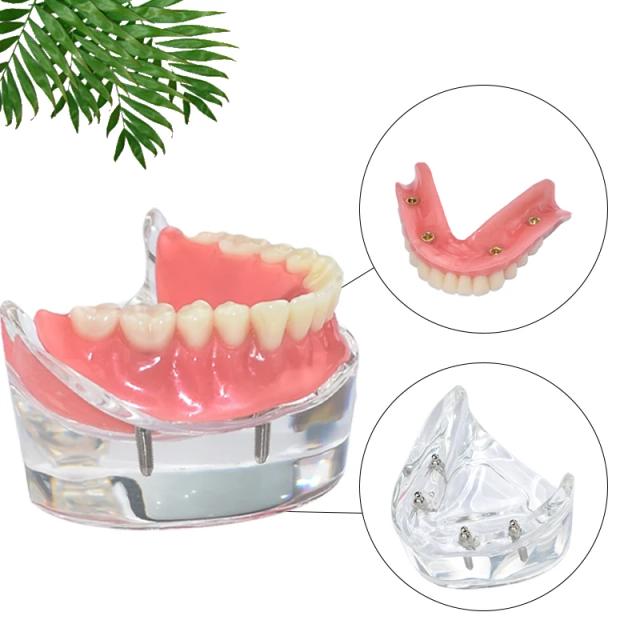 1Pcs Dental Teeth Model Removable Overdenture Lower Jaw 4 Implants M6003 Dentist Teaching Demonstration Model on Productcaster.