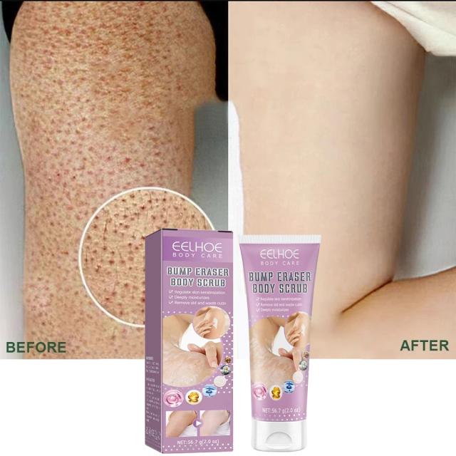 Keratosis Pilaris Cream For Strawberry Legs Removal KP Bump Eraser Dark Spots Face Body Smooth Whitening Moisturizes Skin Care on Productcaster.