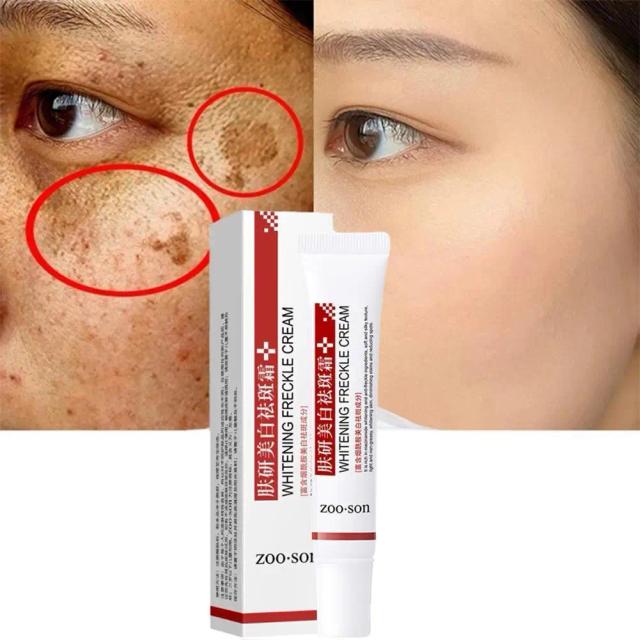 Effective Whitening Freckle Cream Remove Dark Spots Anti Freckle Cream Niacinamide Fade Pigmentation Melasma Brighten Creams on Productcaster.