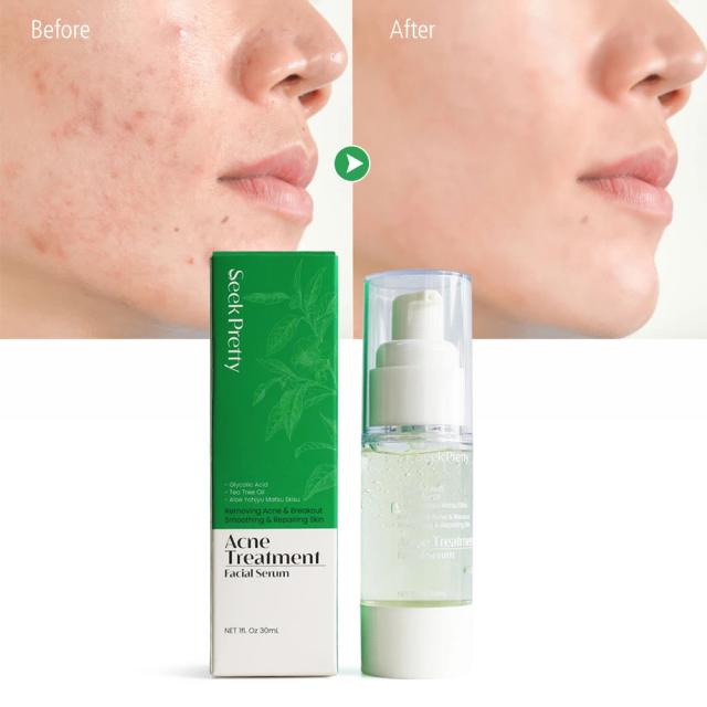 Seekpretty Acne Treatment Facial Serum Removing Acne and Breakout Smoothing Repairing Skin Moisturizing for Healthier Skin on Productcaster.