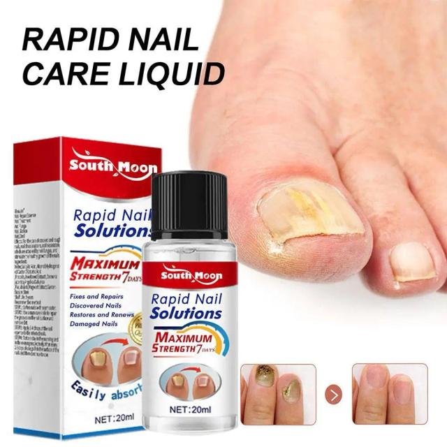 Nail Fungus Treatments Serum 20ml Foot Care Serum Toe Nails Fungal Removal Gel Anti-Infection Toe Fungus Hand Foot Onychomycosis on Productcaster.