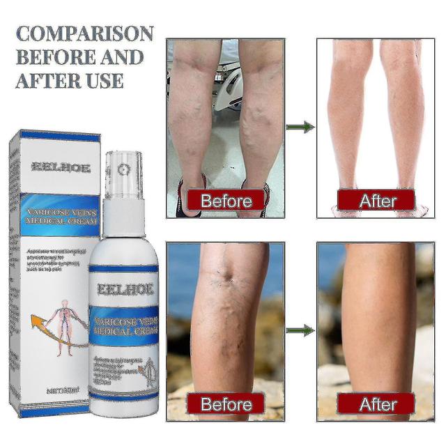 Vein Massage Varicose Vein Spray Soothes Veins, Soothes Worm Legs, Relieves Leg Blood Vessel Pain 30ml Box WFS on Productcaster.