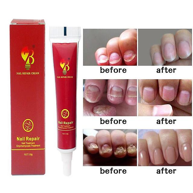 Coscelia Onychomycosis Anti Antibacterial Crean Removal Onychomycosis Bacteria Naturally Ointment Chinese Herbs Medicine on Productcaster.