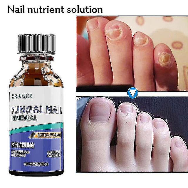 Hot Nail Fungus Treatment Stop Fungal Growth Effective Fingernail & Toenail Health Care Solution Fix & Renew Damaged Cracked-excellent 10ml on Productcaster.