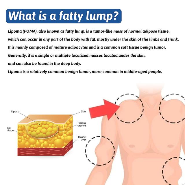 South Moon Fatty Nodules Cream, Relieve Fatty Bumps, Hard Lumps, Tumor Elimination Cream, Improve Fatty Nodules Cream 50g 1pcs on Productcaster.