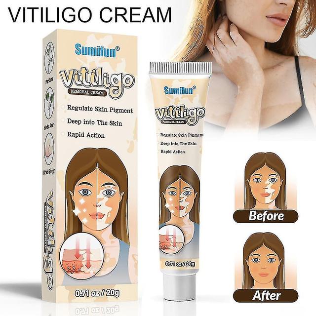 Herbal Extract Vitiligo Ointment Remove Ringworm White Spot Removal Skin Vitiligo Eliminate Vitiligo Treatment Cream on Productcaster.