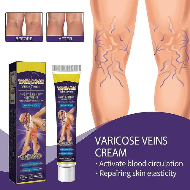 Varicose Vein Cream, Relief Of Leg Varicose Veins, Strengthening Capillary Health, Spider Vein Care Cream 1PCS on Productcaster.