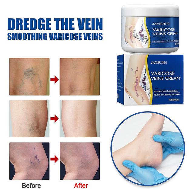 Shihaodian Jaysuing leg vein repair cream varicose massage earthworm leg pain swelling active topical cream on Productcaster.