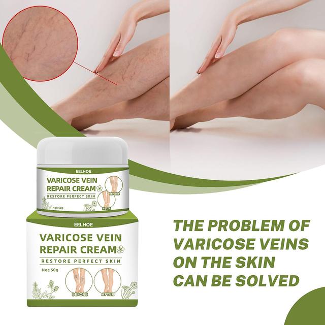 Eelhoe Varicose Vein Repair Cream Tongmai Relieves Leg Varicose Vein Pain Relief Earthworm Leg Pain Red Blood Silk Spider Leg Xinmu on Productcaster.