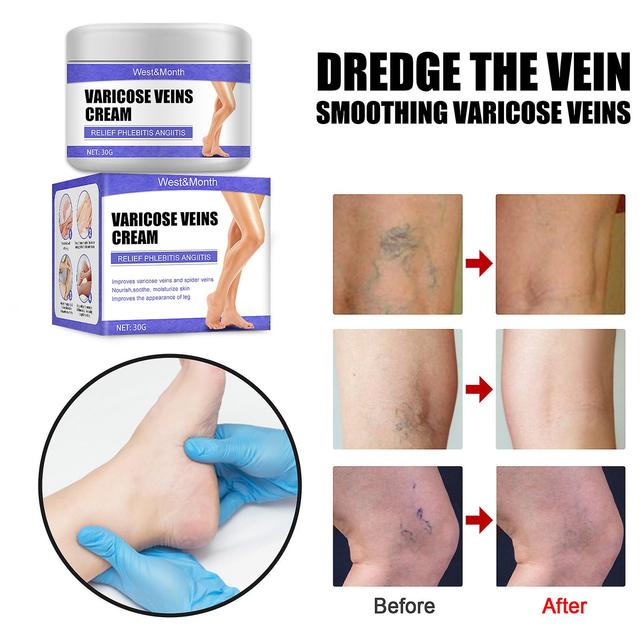 30g Vein Care Fading Cream Varicose Veins Cream For Legs Veins Herbal Ointment on Productcaster.