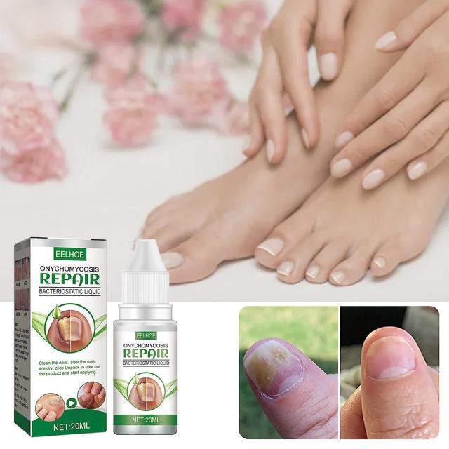 EELHOE Onychomycosis Repair Solution Thickening Onychomycosis Repair Solution Nail thickening, discoloration and peeling off soft nails 20ml box on Productcaster.