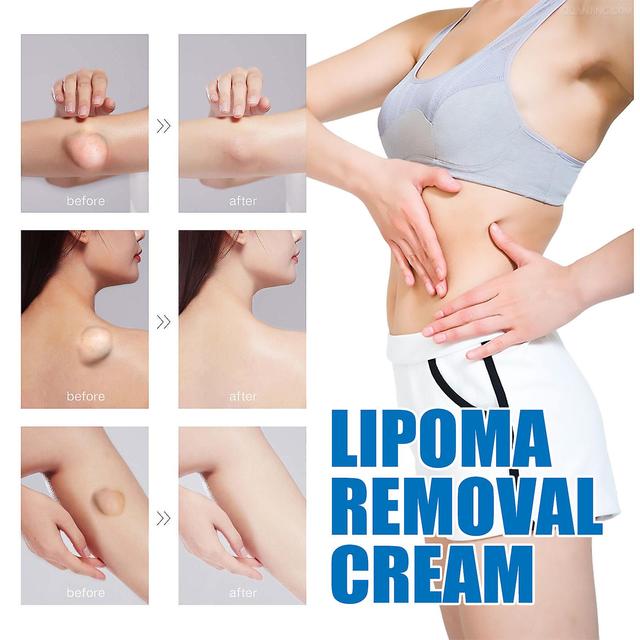 unbrand Fat Knot Cream Relieves Fat Clumps Subcutaneous Lumps Body Care Cream, Relieves Fatty Lumps Tumors Subcutaneous Lumps Unclogging & Eliminat... on Productcaster.