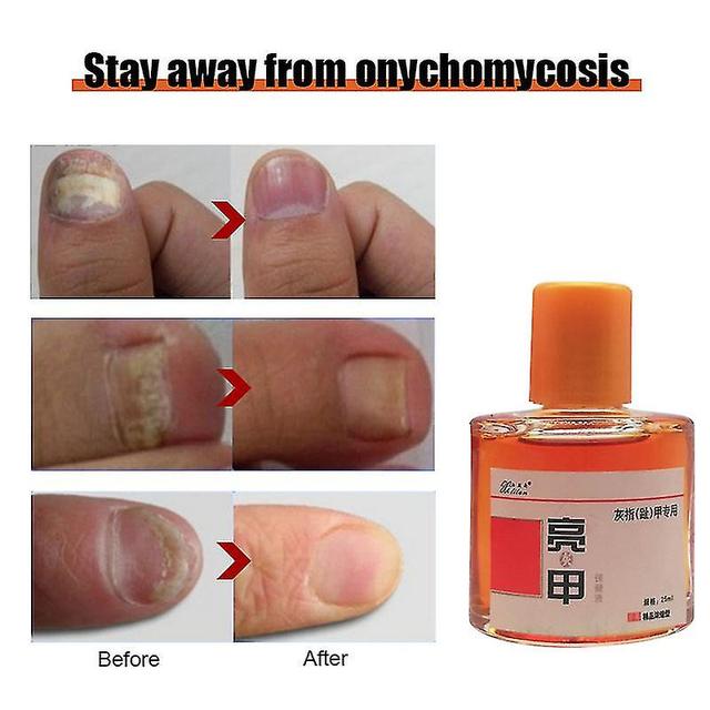 Schan 25ml Bright Nail Health Care-oplossing voor de behandeling van Onychomycose Boutique geconcentreerd extern gebruik om de gezondheid van nagel... on Productcaster.