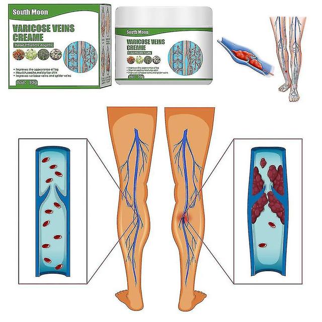 Varicose Vein Cream For Legs Eliminate Varicose Veins And Spider Vein on Productcaster.