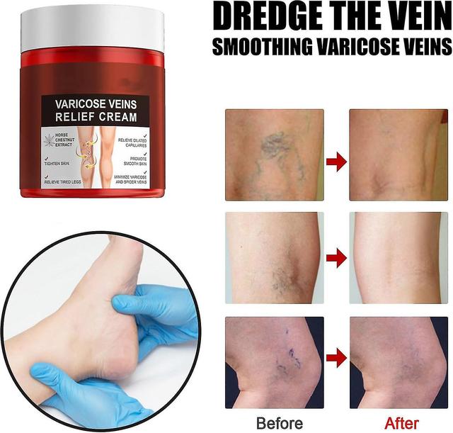 Natural Varicose Veins Cream, Spider Veins Relief for Legs - Strengthen Capillary Health 3Pcs on Productcaster.