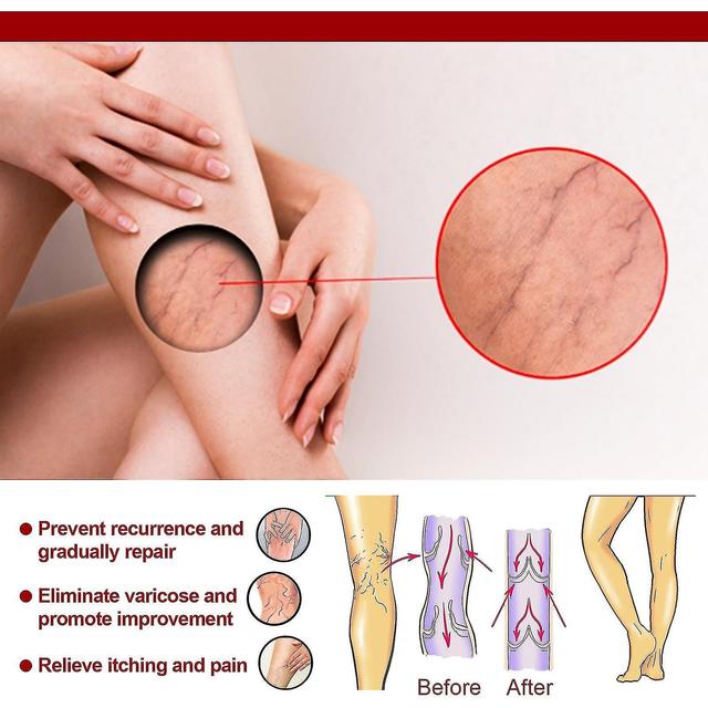 Grace Vein Massage Varicose Ointment Relieves Leg Vascular Swelling Calf Swelling Earthworm Leg Vein Massage Ointment 20g 2PCS on Productcaster.