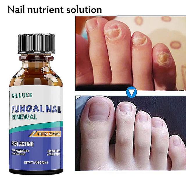 Mja Hot Nail Fungus Treatment Stop Fungal Growth Effective Fingernail & Toenail Health Care Solution Fix & Renew Damaged Cracked 10ml on Productcaster.