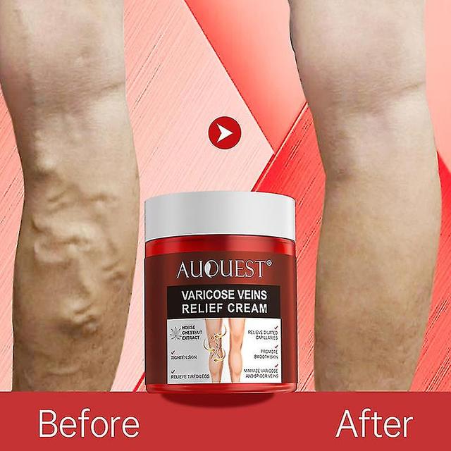 Varicose Veins Relief Cream Body Leg Vasculitis Phlebitis Spider Pain Relie on Productcaster.