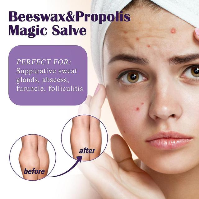 NAILAO Propolis Follicle Cream Subcutaneous Mass Relieves Skin Follicle Net 50g 2pcs on Productcaster.