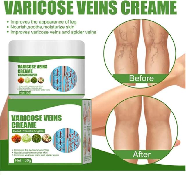 Cremevital Varicose Vein Cream,eliminate Varicose Veins And Spider Veins 3PCS on Productcaster.