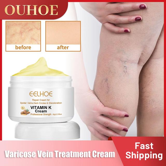 Face Varice Treatment Cream, Medical Ointment, Vasculitis And Phlebitis Dissolving, Repair Of Vitamin K Swelling 60g on Productcaster.