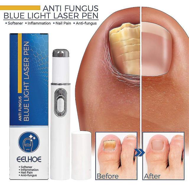 905nm Laser Feet, Therapeutic Whitening, Instruct For Nails, Painless, Elimination Of Nail Fungi, Infection 1pc Repair Pen on Productcaster.