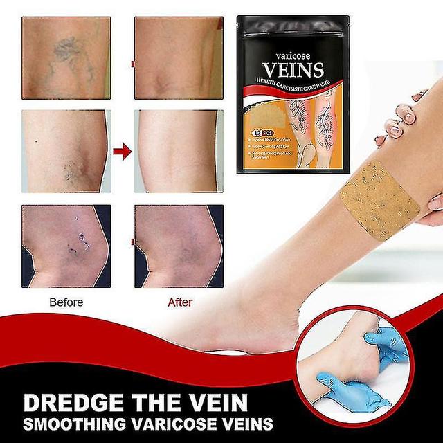 36pcs Veinhealth Varicose Vein Patch For Spider Veins & Varicose Veins Removal Leg Care Improves Blood on Productcaster.