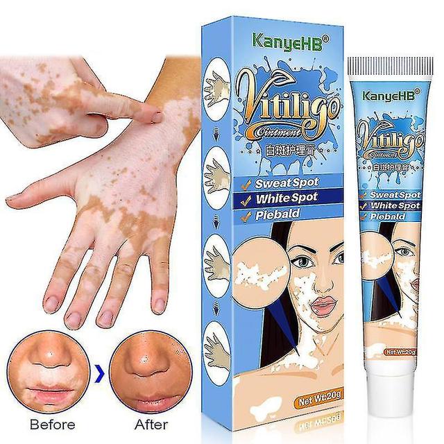 christina show 20g de extracto de hierbas ungüento de vitiligo eliminar la tiña eliminación de manchas blancas de la piel leucoplasia de manchas bl... on Productcaster.