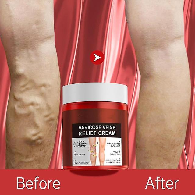 Chicoque Varicose Veins Relief Cream, Varicose Vein Cream For Legs Reduces Spider Veins,varicose Veins Relief For Legs, Strengthen Capillary Health... on Productcaster.