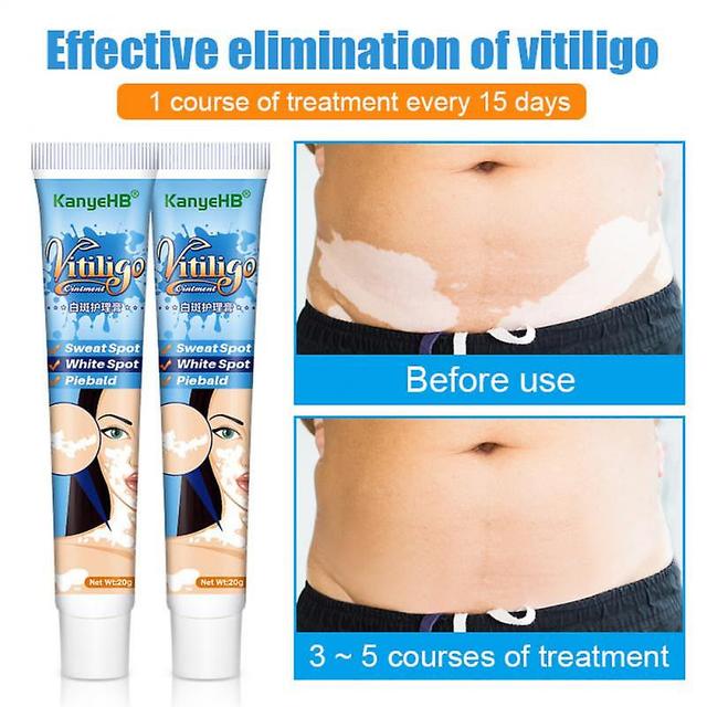 White Tag Traitements Cream Plant Extract Essencial Vitiligo Pommade Retirer on Productcaster.