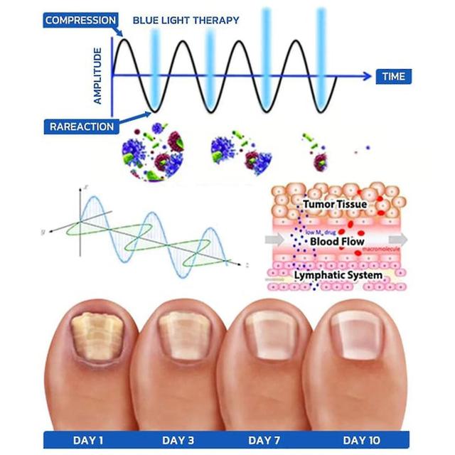 2024 NEW,Nail Fungus Laser Device Light Therapy Onychomycosis Toes Treatment 910nm,50% Offer on Productcaster.