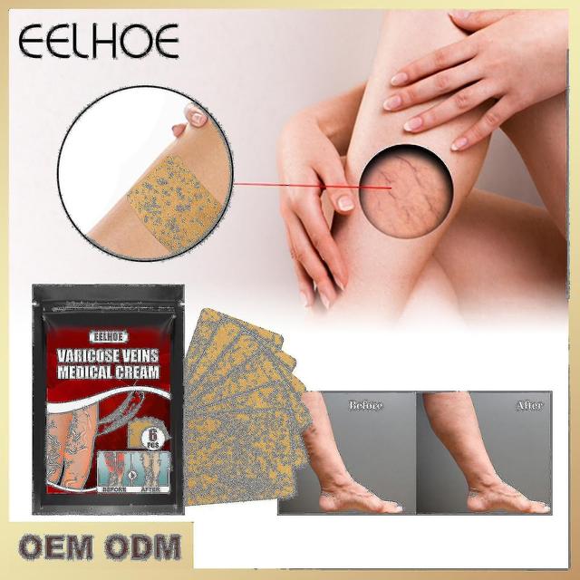 Haoyunlai Eelhoe Varicose Vein Massage Plaster Swollen Leg Earthworm Leg Vein Massage Pain Relief 6pcs Bx on Productcaster.