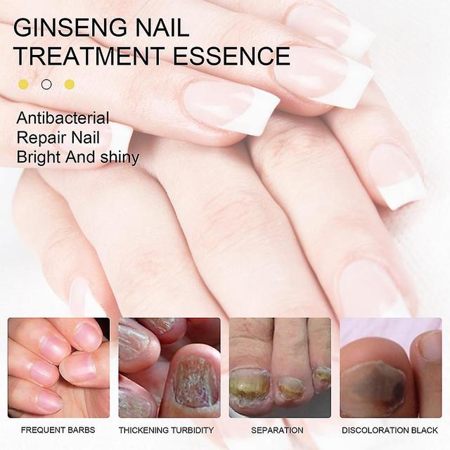 Ginseng Antibakteriella nagelbehandlingar Eteriska olje naglar Svamp Reparation 10ml on Productcaster.