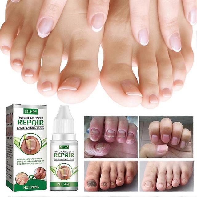 Fungal Nail Repair Drops Fast Nails Fungus Onychomycosis 1pcs on Productcaster.