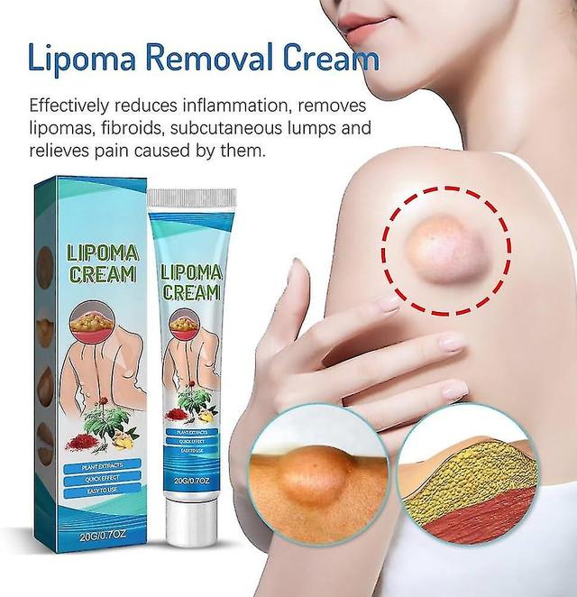 Kry Magical Lipoma Elimination Cream, Removal Relieving Subcutaneous Lumps, Lipoma Removal Cream, Lipoma Cream Made from Natural Herbal Extracts 1pcs on Productcaster.