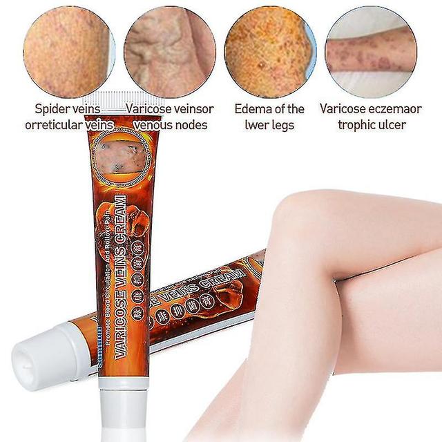 1pcs 20g Varicose Veins Ointmnet Vasculitis Phlebitis Spider Cream Varicosity_Feb 3PCS on Productcaster.