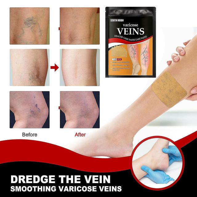 Shihaodian South Moon Vein Health Patch Relieves Varicose Vein Blockage And Raised Cold Compress Vein Health Patch In The Feet Massage Oil1pcs) -GSL on Productcaster.