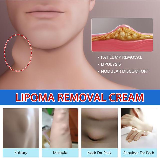 South Moon Fatty Knot Cream, relieve fat lumps, subcutaneous lumps, clear knots, body care 20g (5 pieces) on Productcaster.