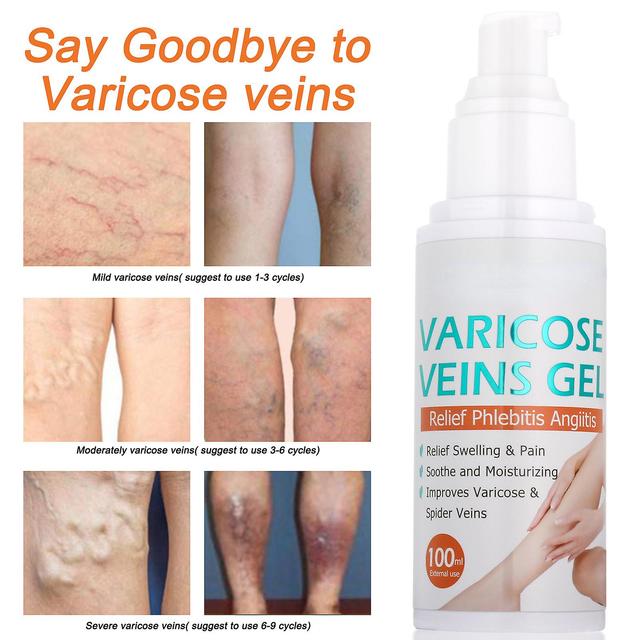 Frusde Varicose Veins Gel, Veincare Moderate Gel, Spider Vein Cream For Legs, Improve Blood Circulation, Improve Blood Circulation 3pcs on Productcaster.