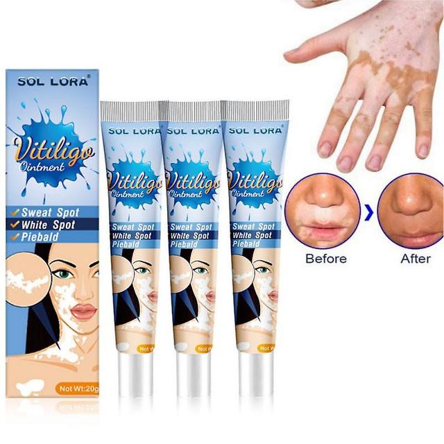 3x Herbal Extract Vitiligo Ointment Remove Ringworm White Spot Removal Skin Vitiligo Eliminate Vitiligo Treatment Cream on Productcaster.