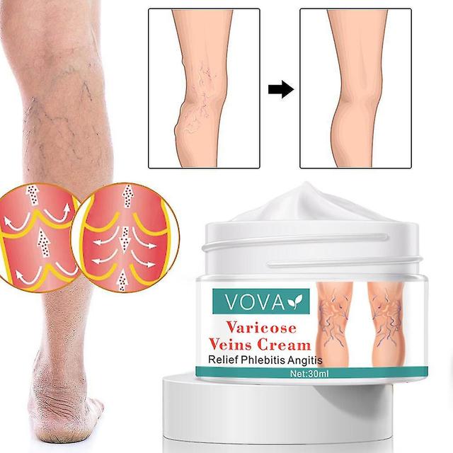 Varicose Extension Cream Body Care Herbal Medicin Treatment Vasculitis Phlebitis Pain Spider Legs Ointment Health Products- on Productcaster.