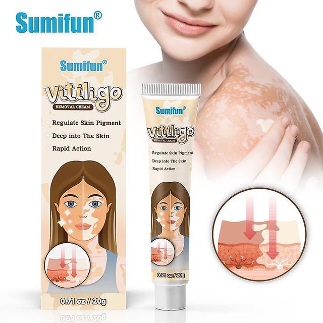 1-5pcs Herbal Extract Vitiligo Ointment Remove Ringworm White Spot Removal Skin Vitiligo Eliminate Vitiligo Treatment Cream 1pcs on Productcaster.